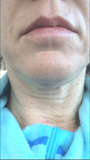 Intense Pulsed Light (IPL) Treatment