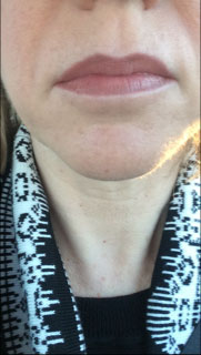Intense Pulsed Light (IPL) Treatment Great Results