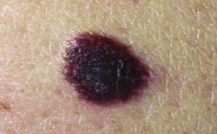 Mole Removal