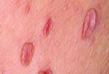 Skin Tag Removal